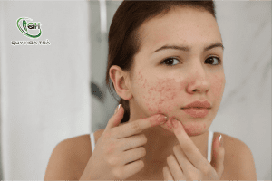 Uống thuốc mát gan có hết mụn không