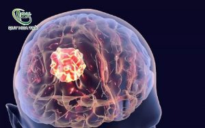 Bệnh tai biến mạch máu não: Triệu chứng và cách phòng tránh