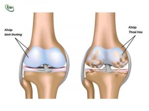 bệnh cơ xương khớp